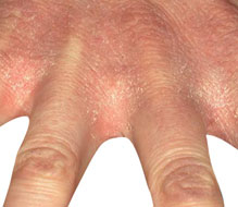 handeczeem-nitrilallergie-handschoenen-dermatitis